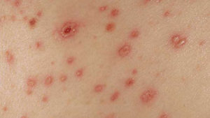  Symptômes de la varicelle